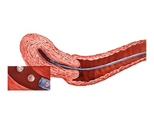 什么是事后避孕，事后避孕的方法