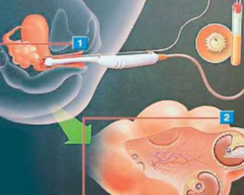 美国试管婴儿冷冻胚胎的复苏率与成功率